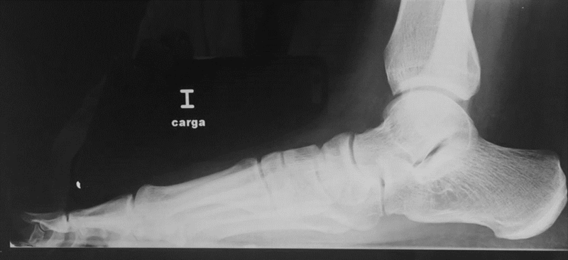 Radiografía de pie Espolón calcáneo por Clínica Fuensalud