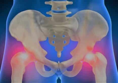 Fisioterapia a domicilio en prótesis de cadera por Clinica Fuensalud