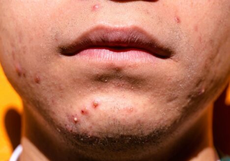 Acné juvenil tratado con acupuntura por Clínica Fuensalud