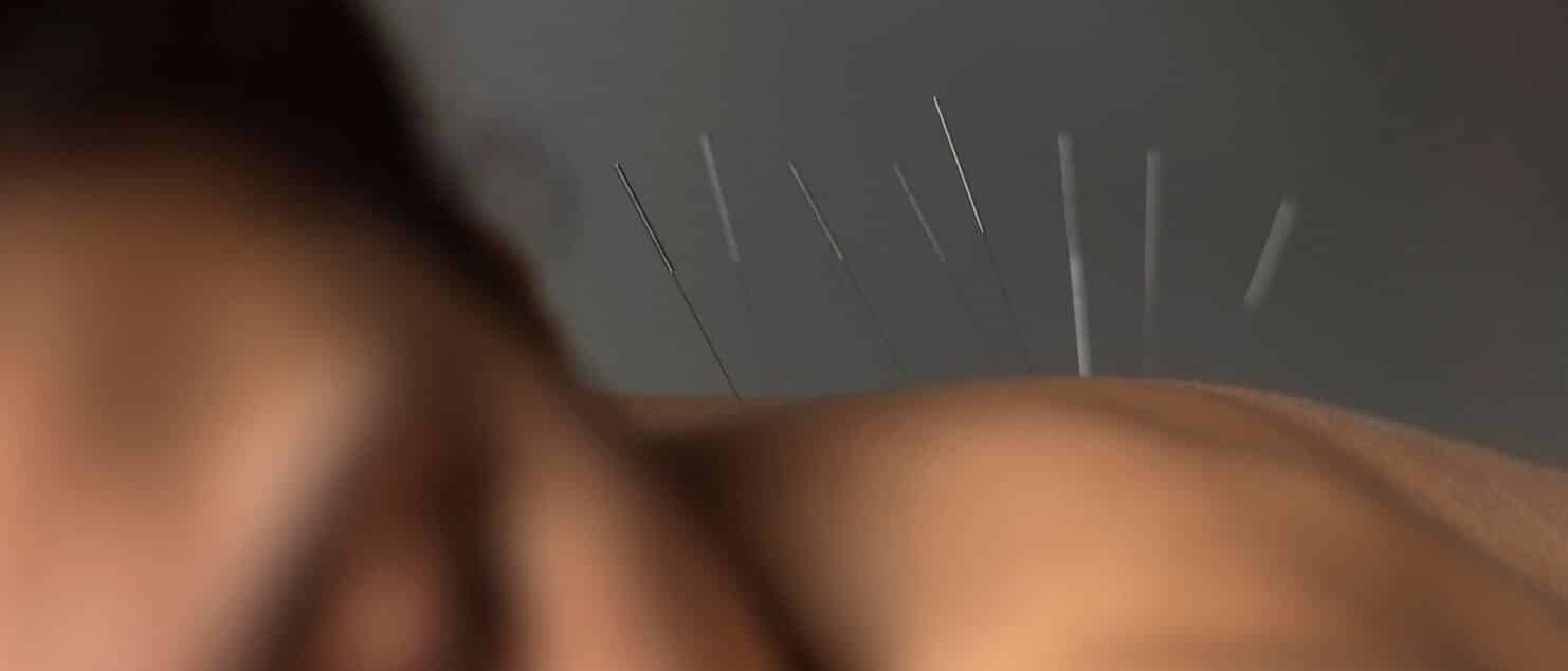 PUNCIÓN SECA VS MASAJE DESCONTRACTURANTE por Clínica Fuensalud